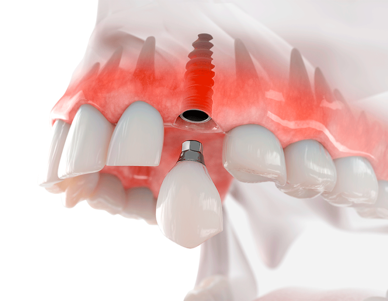 implant-dental implante dental -Dr Omar Lugo Cancún Quintana Roo