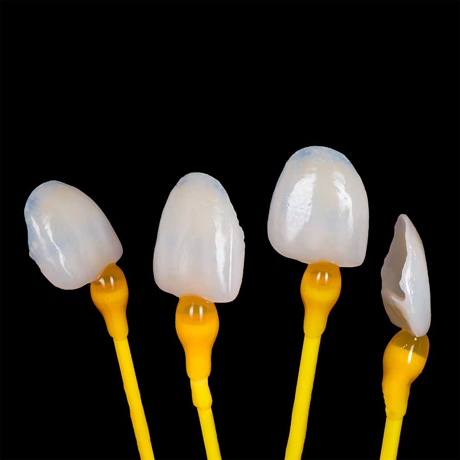 Dental Veneers o carillas dentales de porcelana o zirconia.