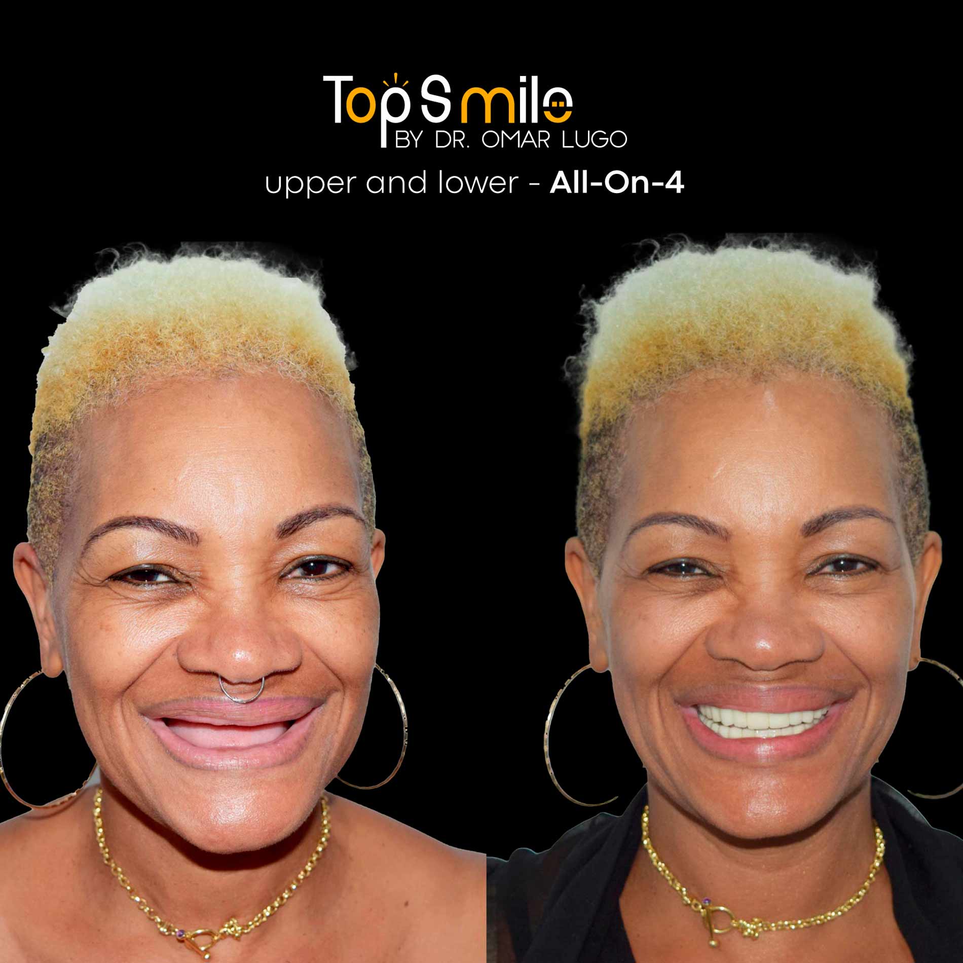 01-all-on-4-uppper-Marzo-Dr-Omar-Lugo-dental-veneers-carillas-dentales-implante-dental-dental-implant-cancun