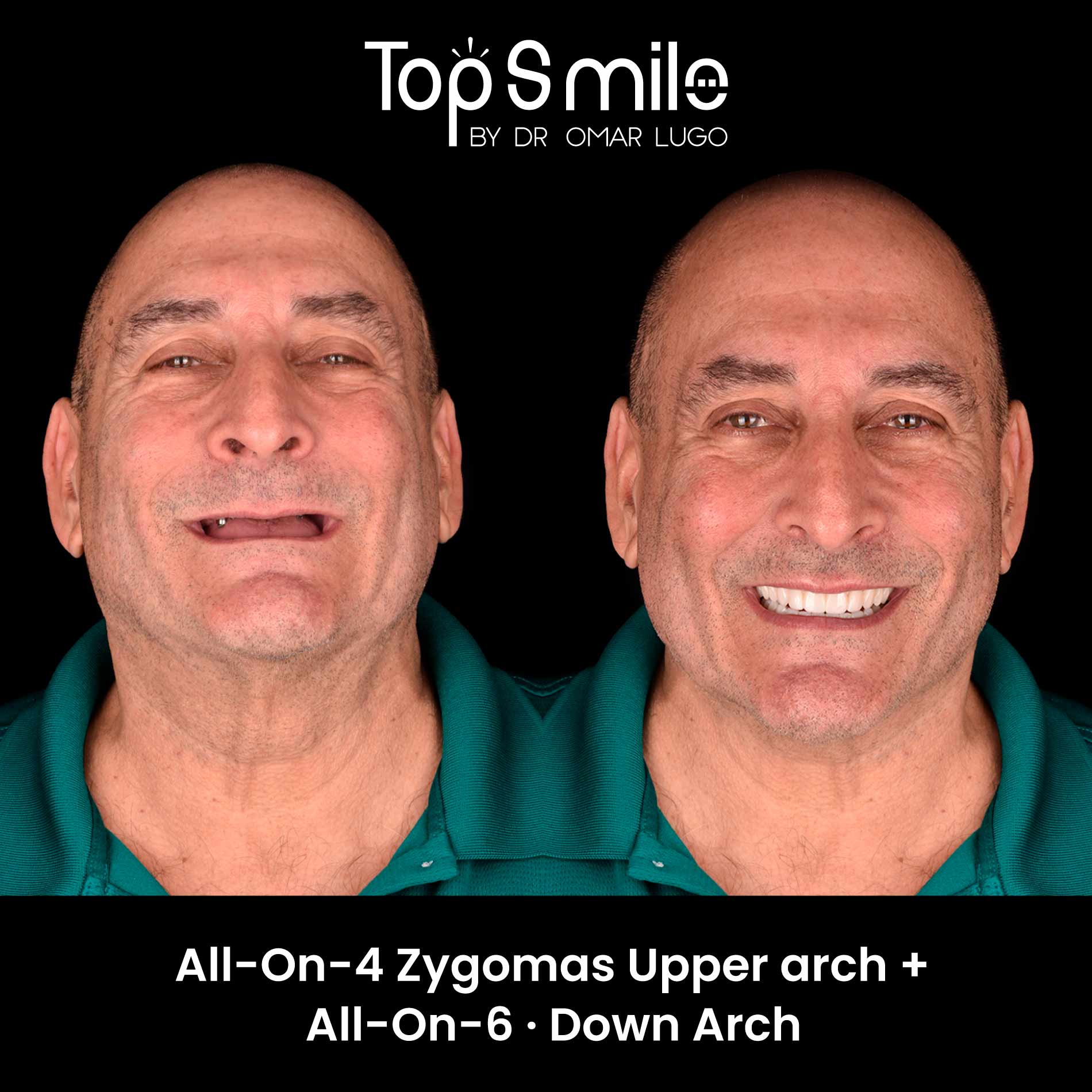 all-on-4-zygomatic-uppper-arch+all-on-6-down-arch-Marzo-Dr-Omar-Lugo-dental-veneers-carillas-dentales-implante-dental-dental-implant-cancun