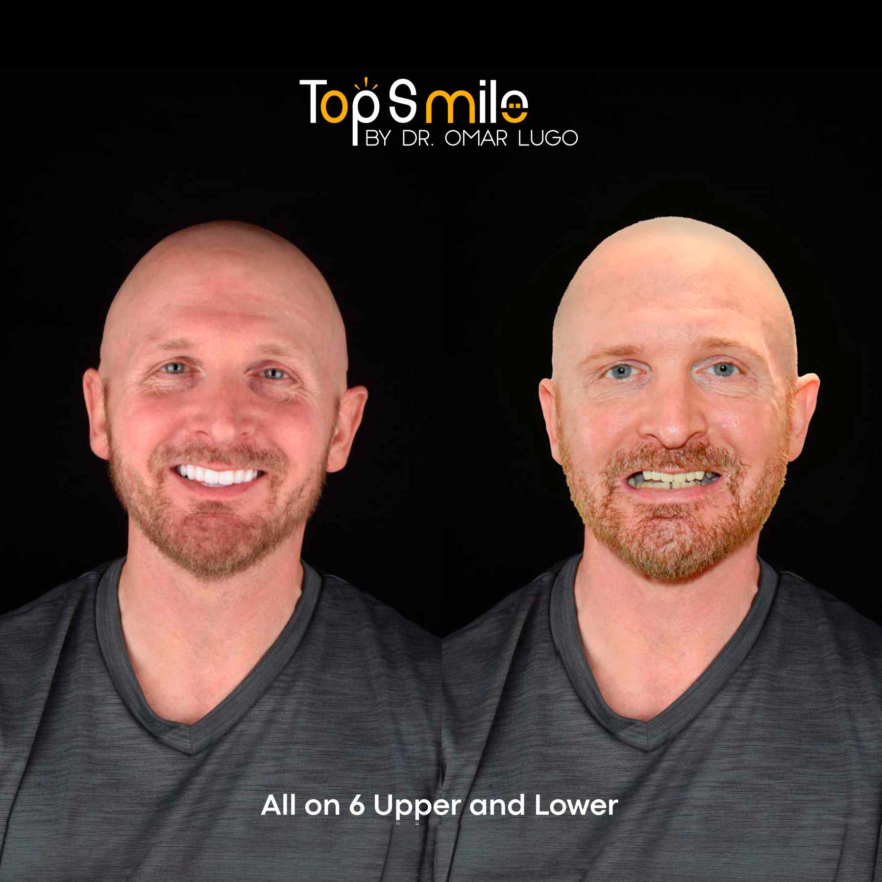 all-on-6-uppper-Marzo-Dr-Omar-Lugo-dental-veneers-carillas-dentales-implante-dental-dental-implant-cancun