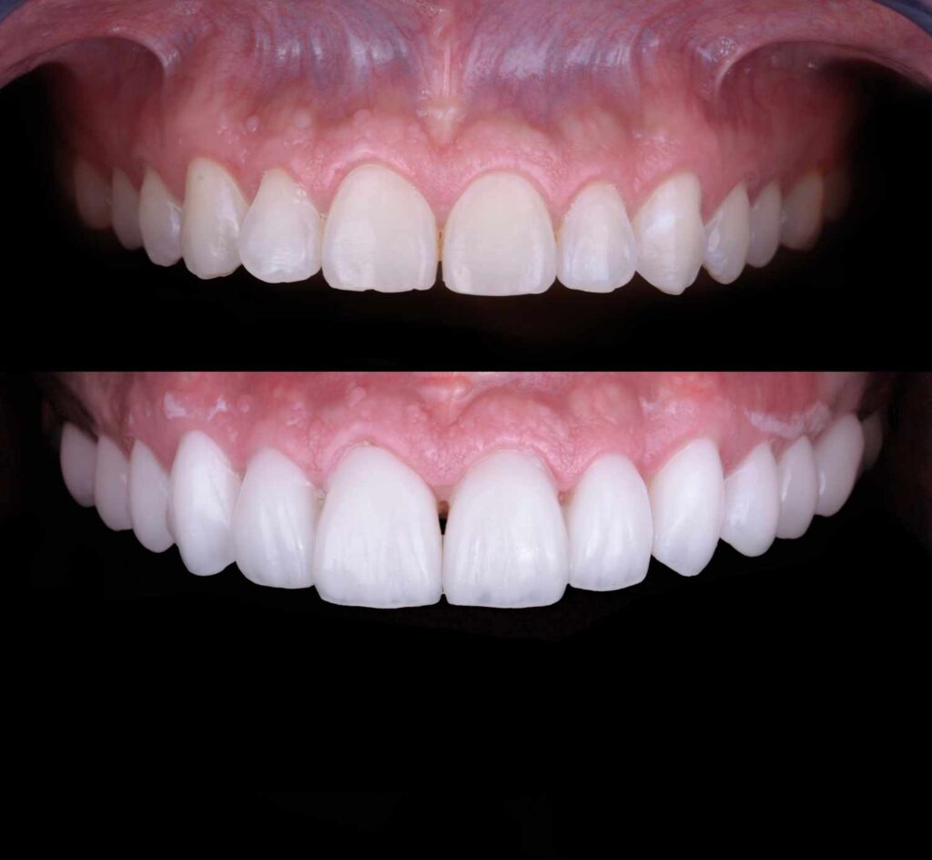 Dental veneers in Cancun