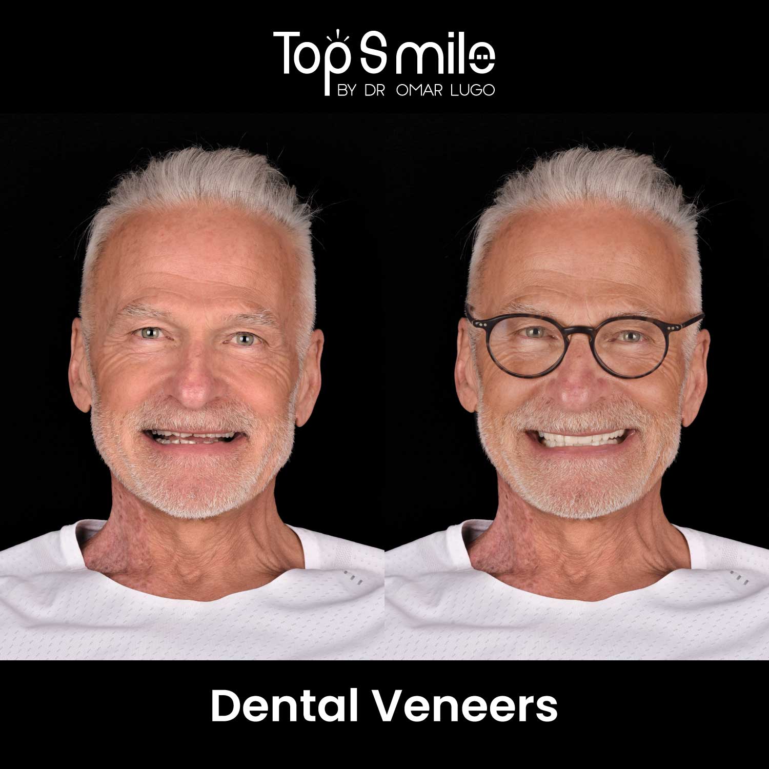 Dental veneers in Cancun