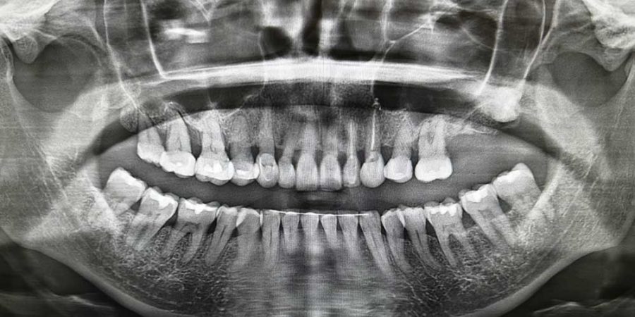 Se utilizan radiografías como estudios complementarios para realizar un adecuado diagnóstico de la enfermedad periodontal.